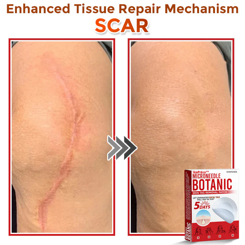 🌈SkinPrikyn™ MicroNeedle Botanic Skin Tag Removal Patch