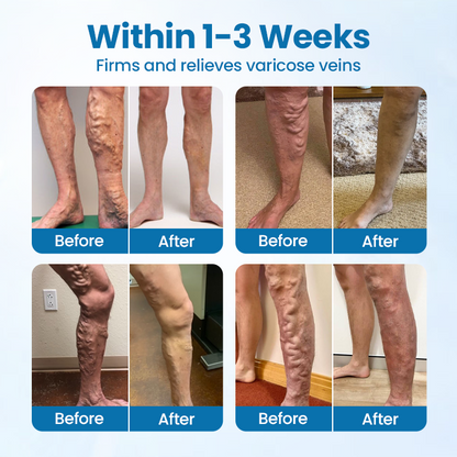ODEIUN® VeinGuard Herbal Spray-✅ Clinically proven to eliminate varicose veins in just 7 days!