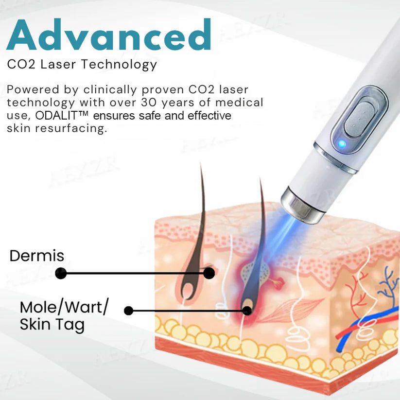 ODALIT™ Non-Invasive Mole and Wart Removal Laser Pen