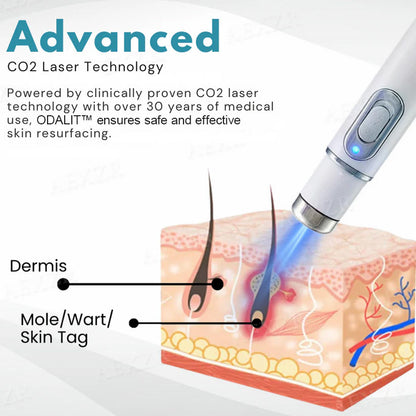 ODALIT™ Non-Invasive Mole and Wart Removal Laser Pen