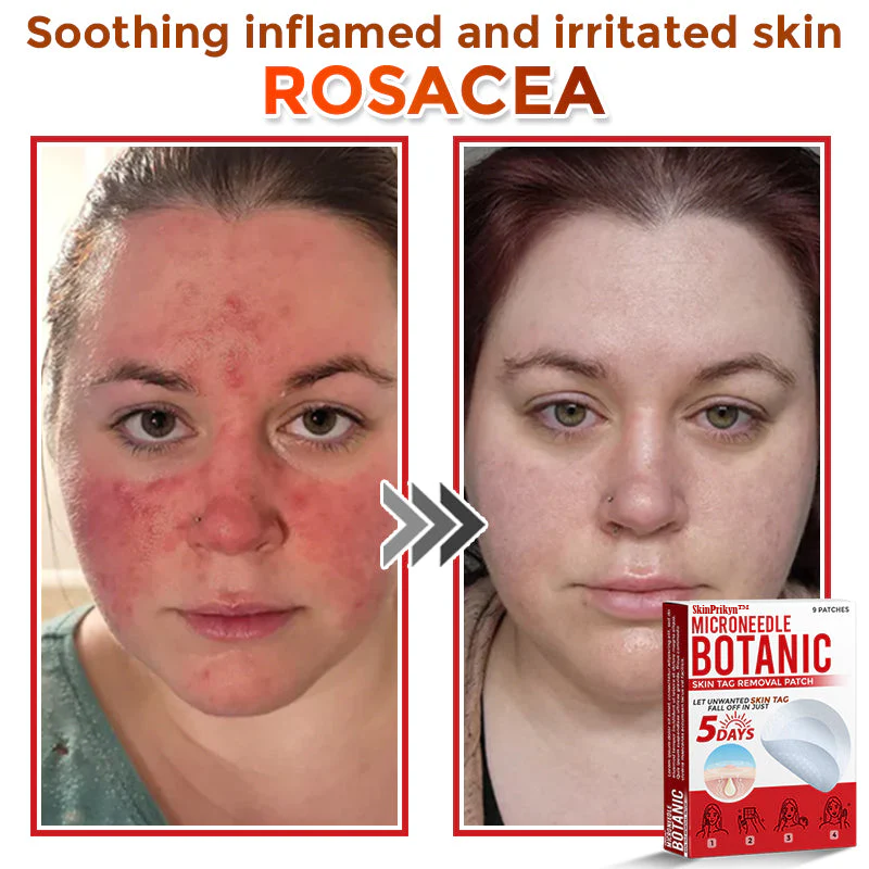 🌈SkinPrikyn™ MicroNeedle Botanic Skin Tag Removal Patch