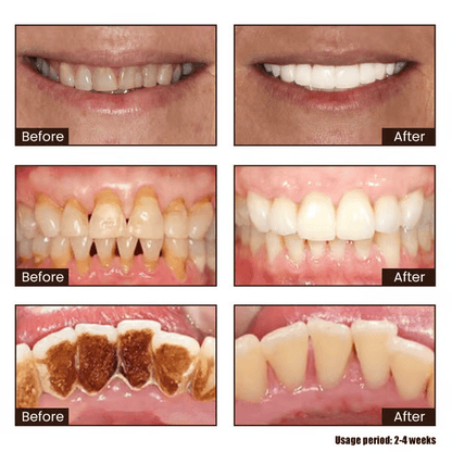 ✨ Achieve a Radiant Smile - 49% OFF - 🦷 Niacinamide Whitening Toothpaste - For Healthier, Whiter Teeth!