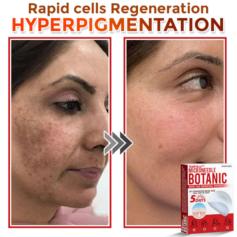 🌈SkinPrikyn™ MicroNeedle Botanic Skin Tag Removal Patch