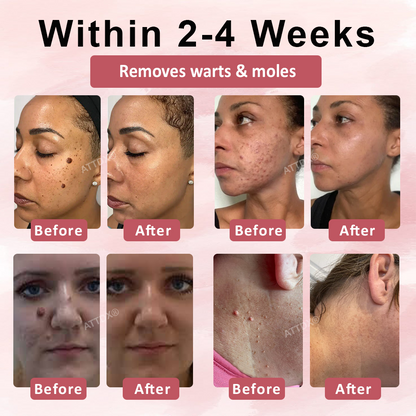 ODEIUN® Tag & Blemish Peel-Off Gel Wrapping Mask